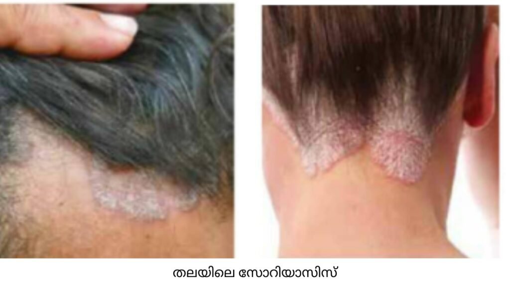 dandruff skin disease causes treatment