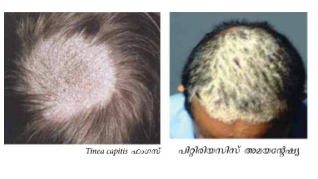 dandruff skin disease causes treatment solution