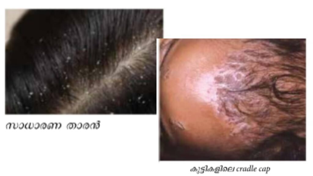 dandruff skin disease causes treatment