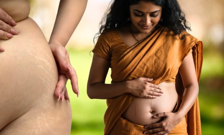 Things to Note to Prevent Stretch Marks