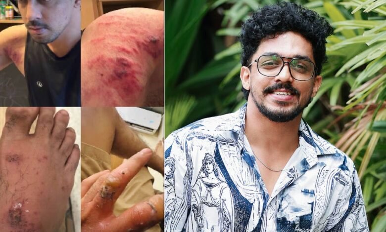 Actor Sagar Surya Injured